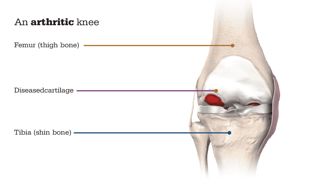 Robotic Total Knee Replacement using advanced Mako robotic technology for precise knee joint alignment and faster recovery